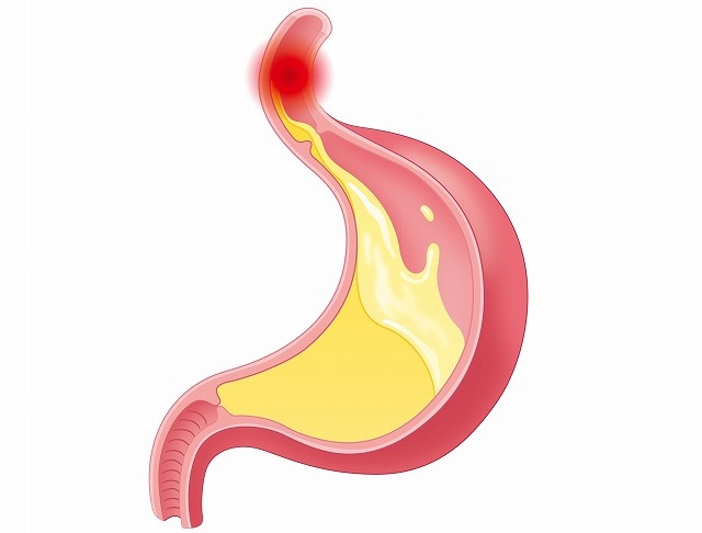 胸やけの原因は逆流性食道炎？