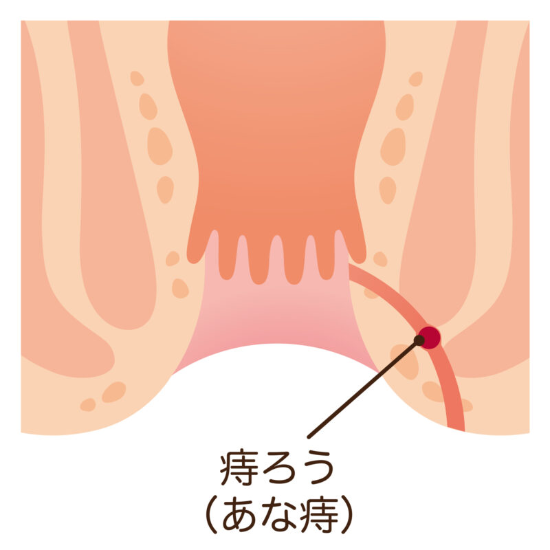 痔瘻（じろう）