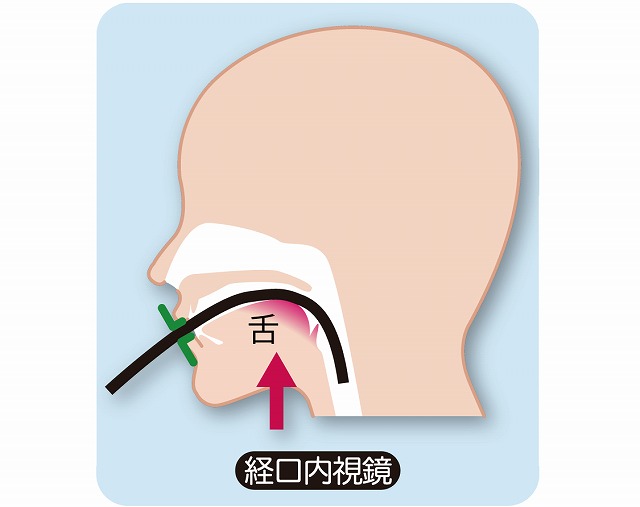 経口内視鏡検査（経口胃カメラ検査）